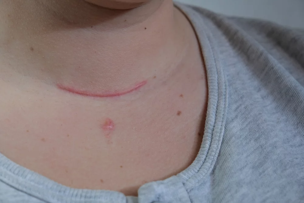 Scars on the neck following traditional thyroid surgery.