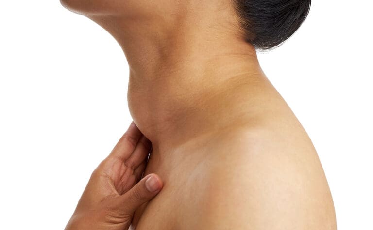Side view of an enlarged thyroid gland