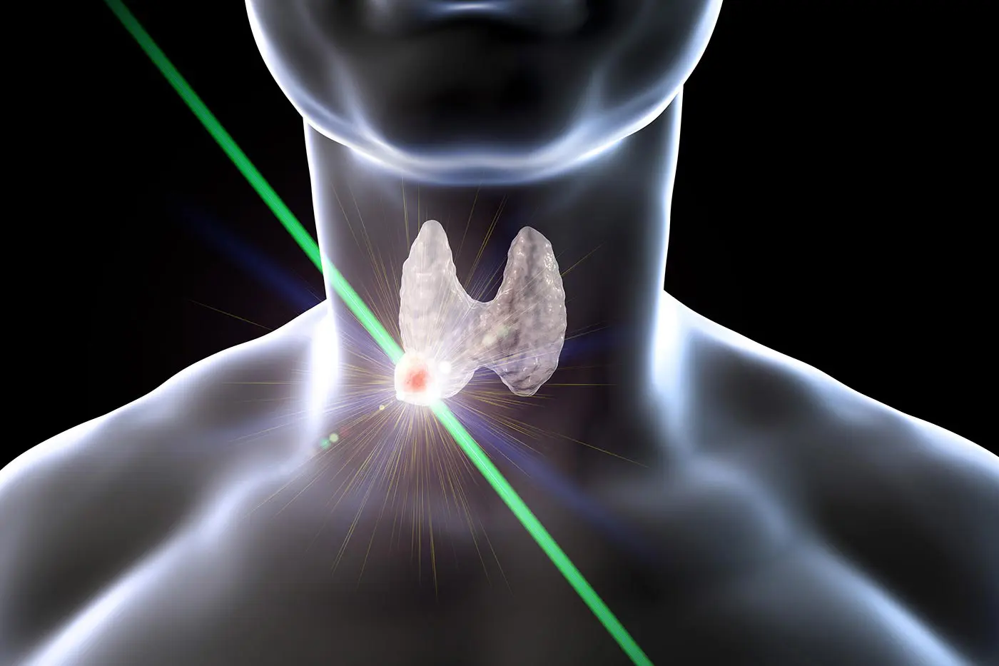 3D rendering of a thyroid nodule being destroyed by ablative energy.