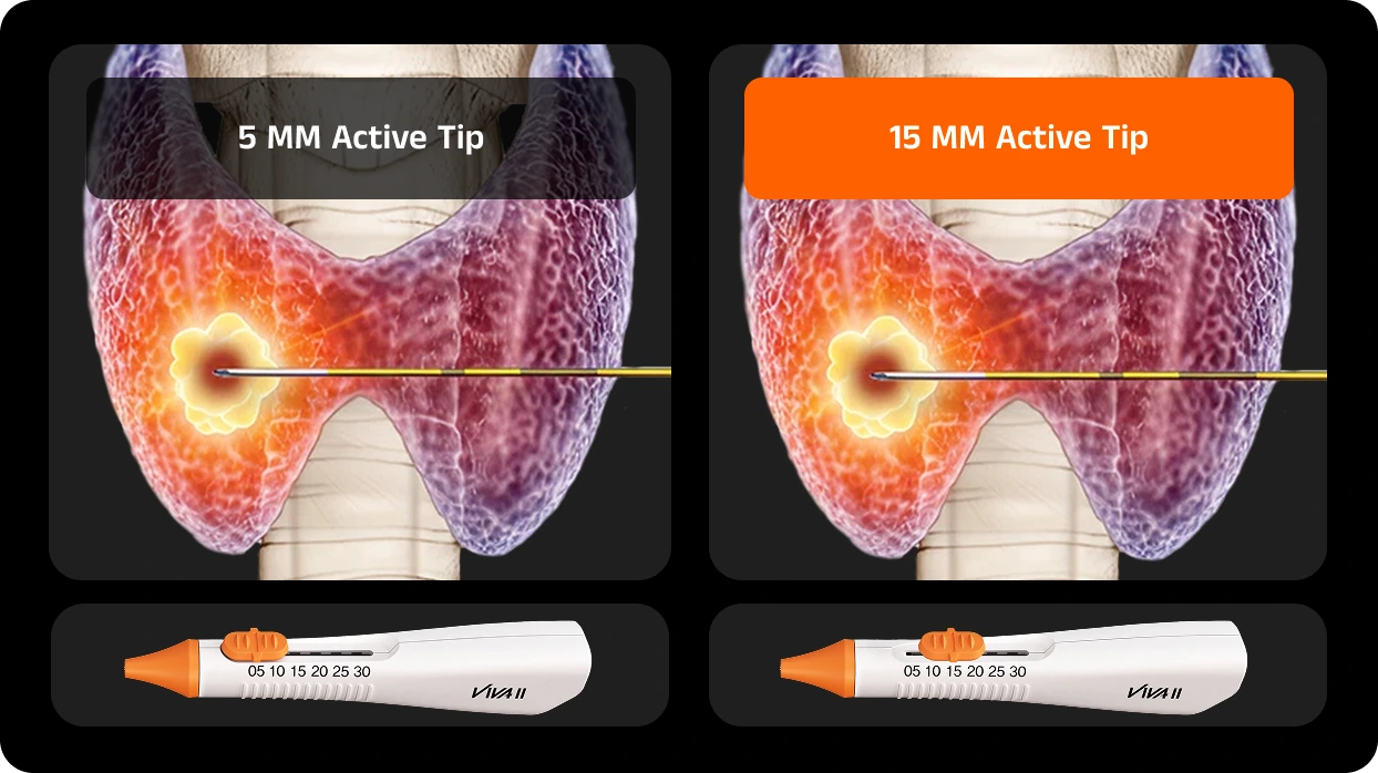 What Key Techniques are Used in Thyroid RFA?