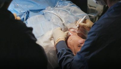 STARMED Radiofrequency Ablation (RFA)