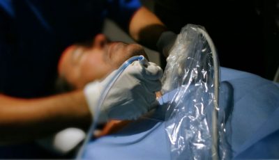 STARMED Thermal Ablation Procedure