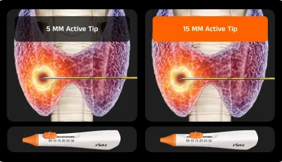 What Key Techniques are Used in Thyroid RFA?