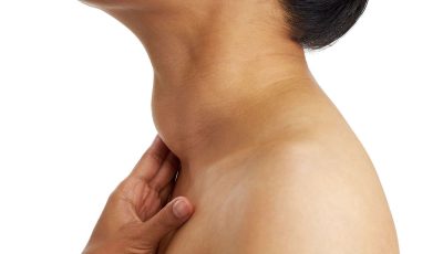 Side view of an enlarged thyroid gland