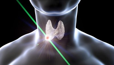 3D rendering of a thyroid nodule being destroyed by ablative energy.