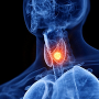 Thyroid Nodule