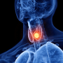 Thyroid Nodule