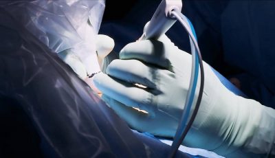 Viva II being used in procedure